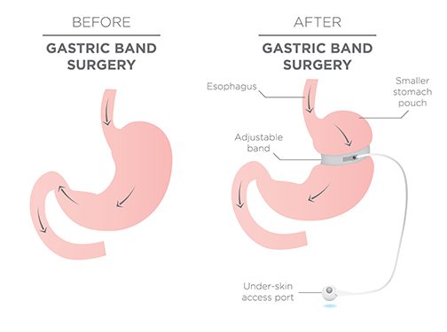LAP BAND Surgery Laparoscopic Adjustable Gastric Banding Suwanee