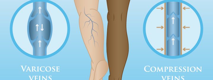 How To Keep Your Veins Healthy Johns Creek Alpharetta Roswell The