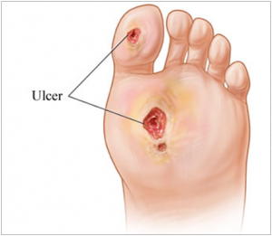 Foot ulcer - Wound Healing Trials