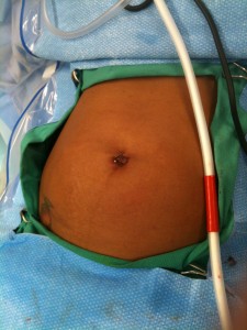 gastric sleeve incisions