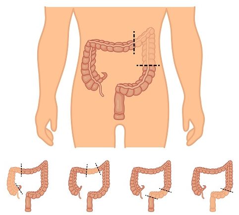 cancer colon resection)