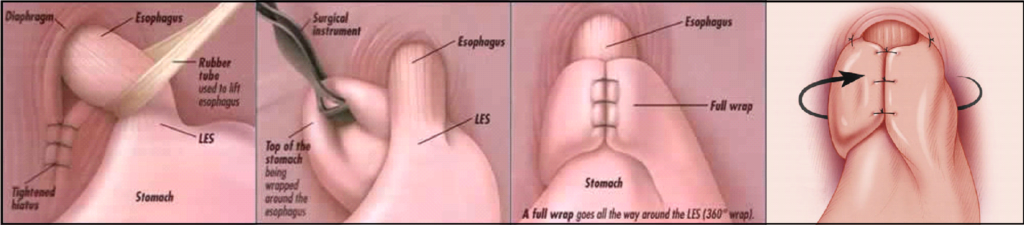 Fundoplication-1024x225