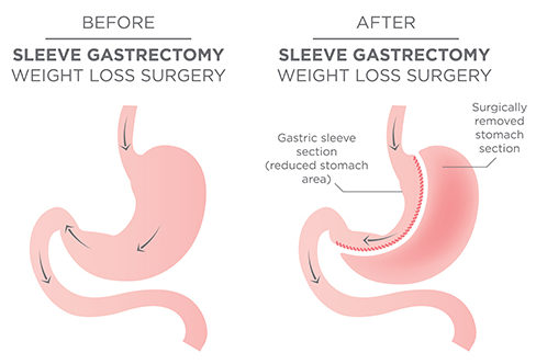 Procedure - Sleeve gastrectomy