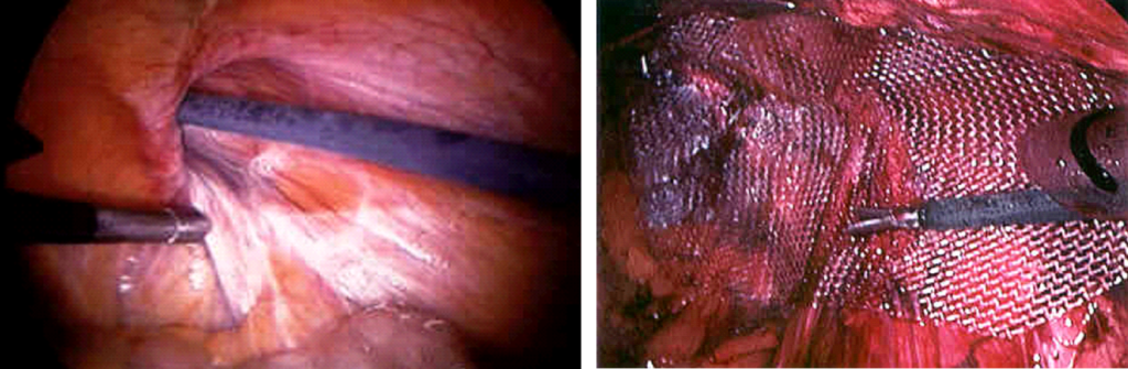 Open and Laparoscopic Repair of Femoral Hernia