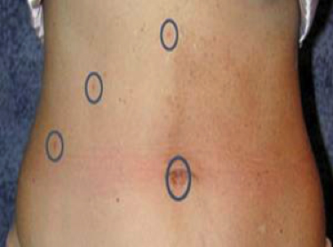 healed gallbladder removal scars