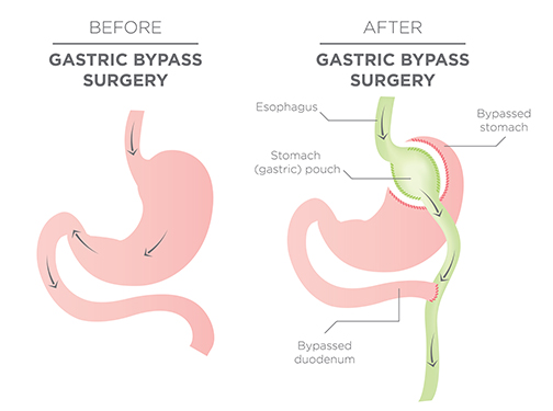 “Gastric_Bypass_Surgery