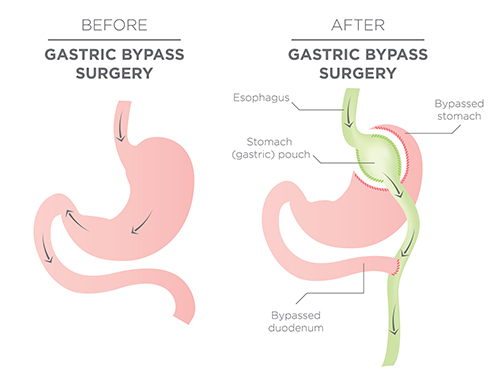 gastric-bypass-new-jersey-advanced-surgical-solutions