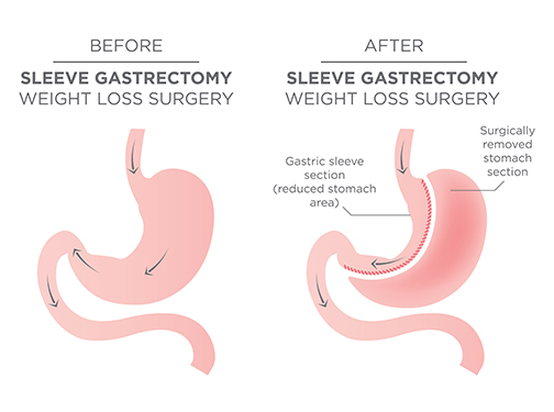 partial gastrectomy