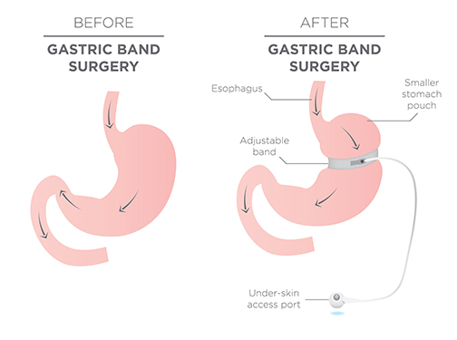 Lap Band Surgery Laparoscopic Adjustable Gastric Banding