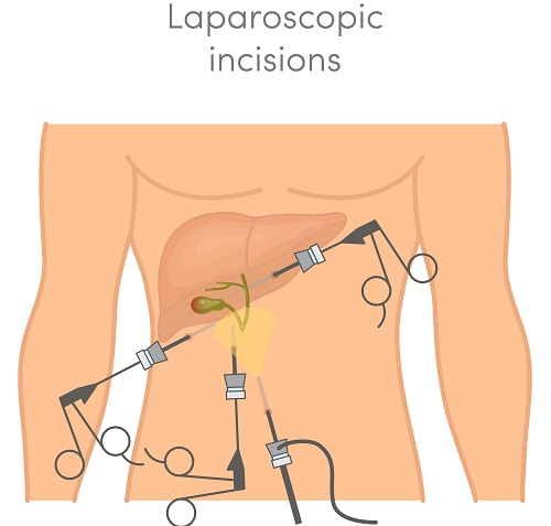 Frequently Asked Questions on Operative Technique of Laparoscopic