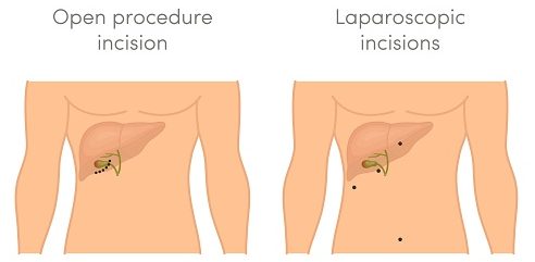 Open-vs-Laparo-Scar-e1487604029867