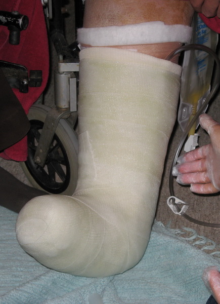 walking cast for plantar fasciitis treatment
