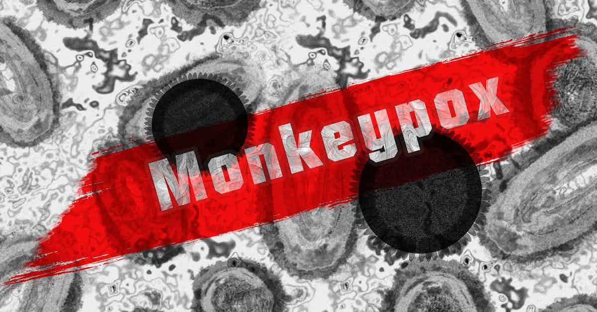 hMPXV Virus aka Monkeypox