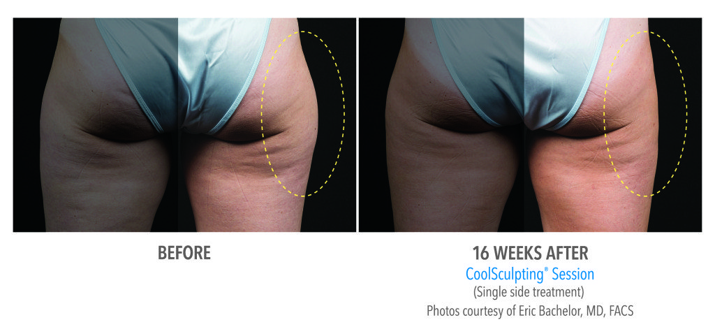 Body Contouring