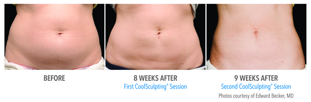 Body Contouring
