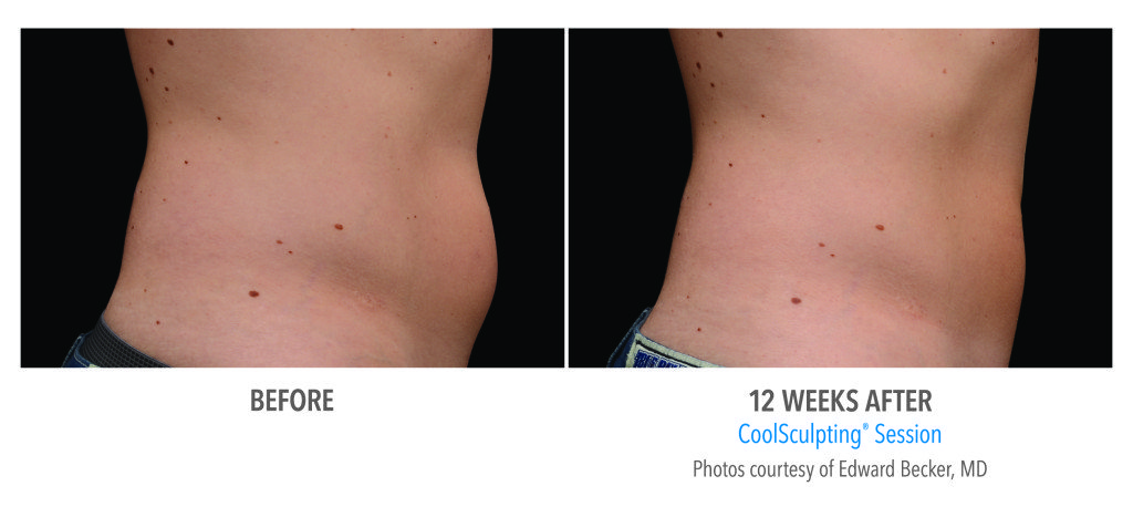 Body Contouring