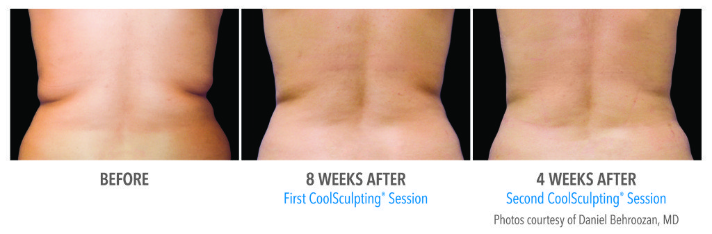 Body Contouring
