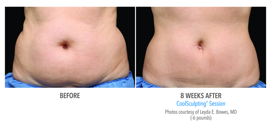 Body Contouring