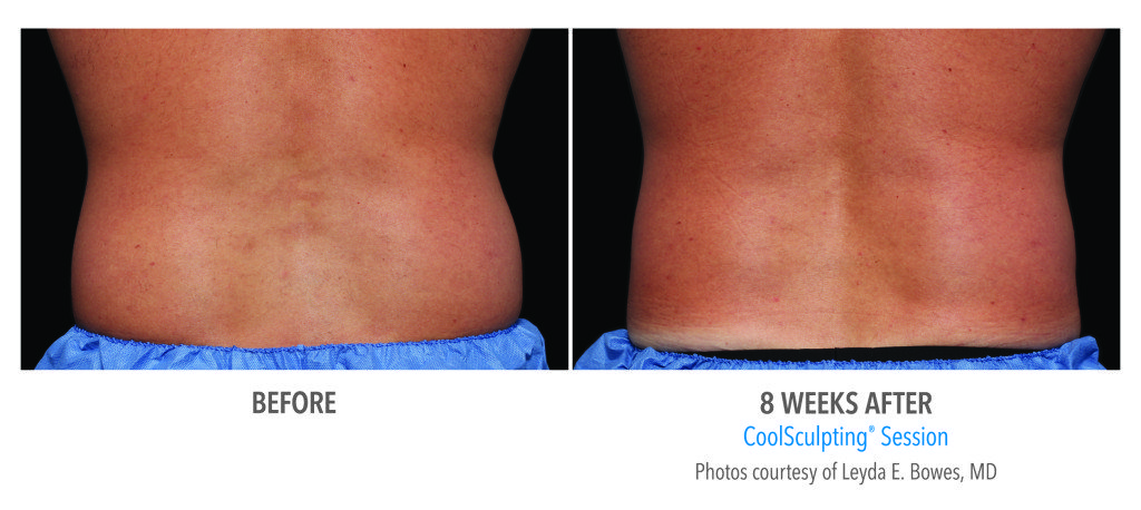 Body Contouring