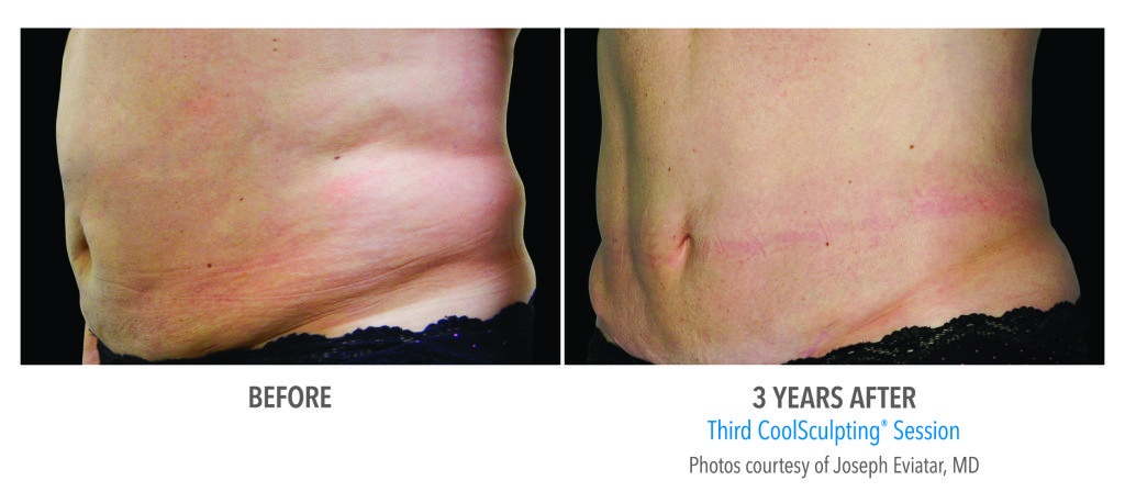 Body Contouring