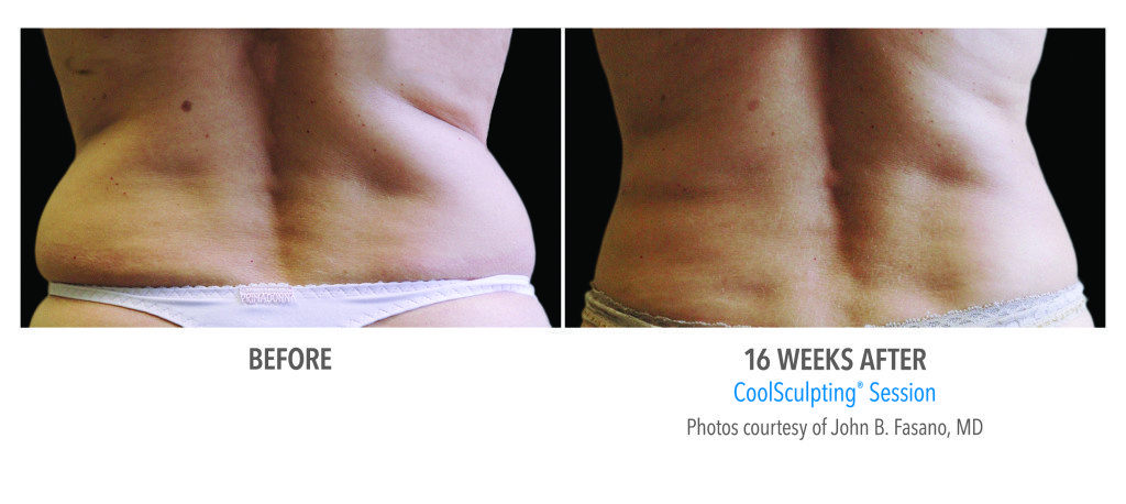 Body Contouring