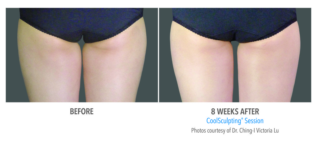 Body Contouring
