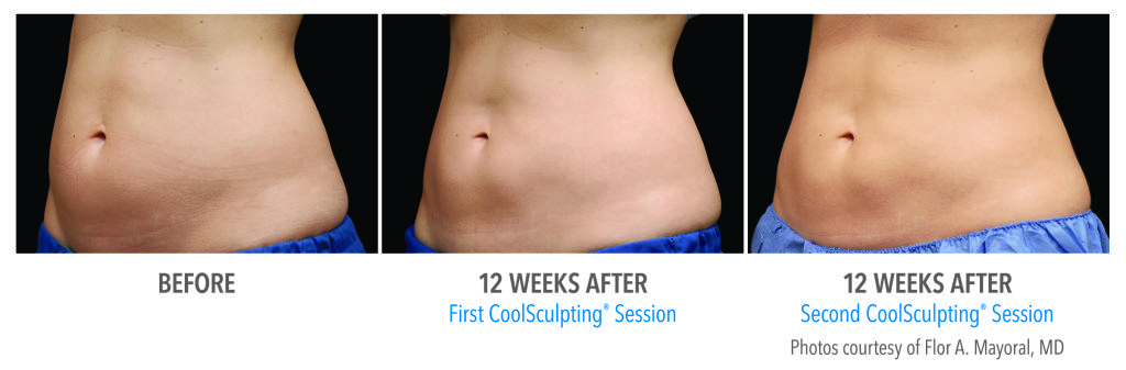 Body Contouring
