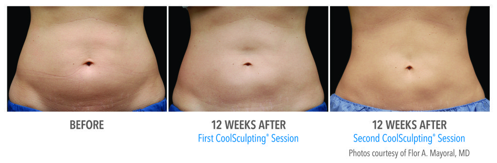 Body Contouring
