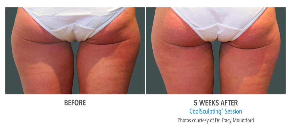 Body Contouring