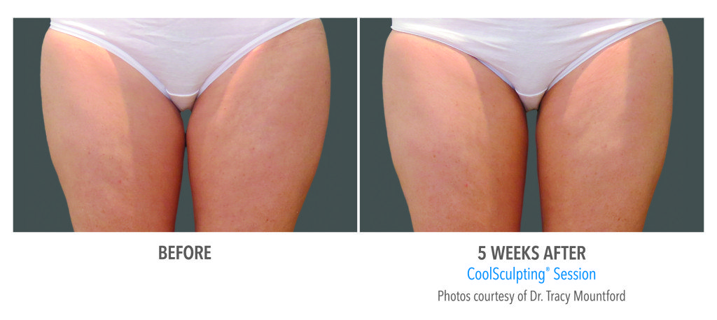 Body Contouring