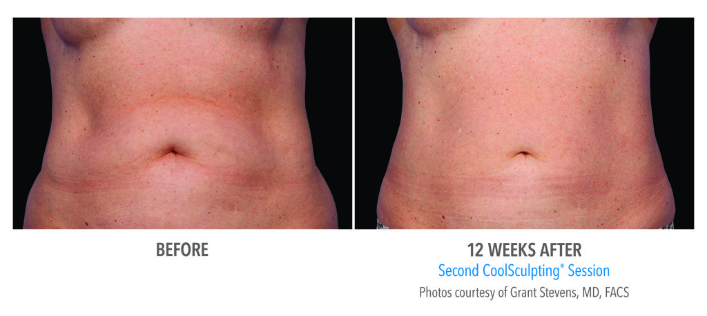 Body Contouring