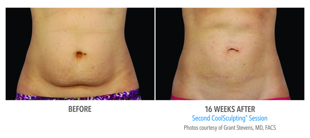 Body Contouring