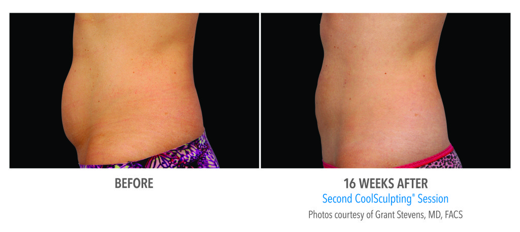 Body Contouring