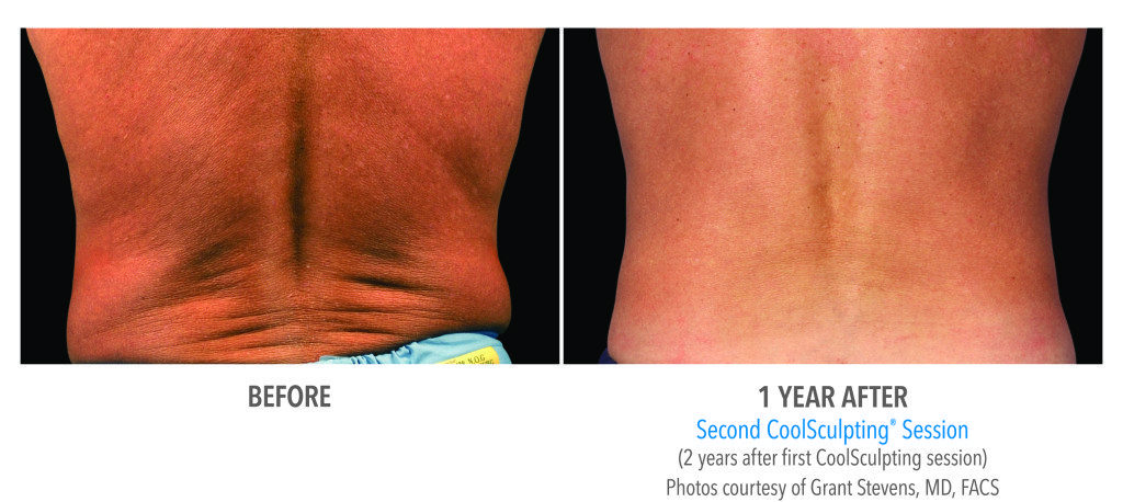 Body Contouring