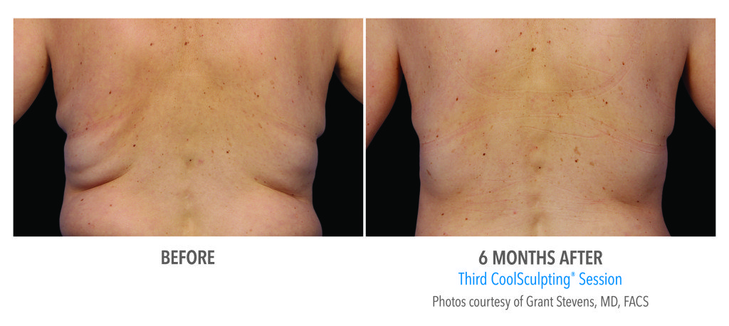 Body Contouring