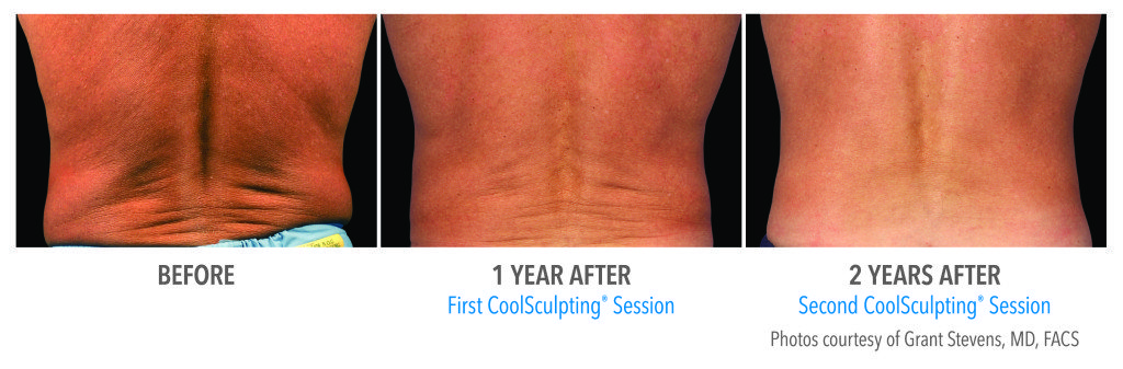Body Contouring