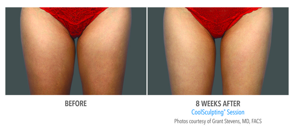Body Contouring