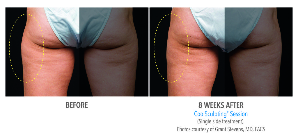 Body Contouring