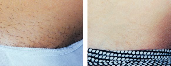 Laser Hair Removal Image