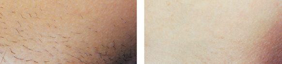Laser Hair Removal Image