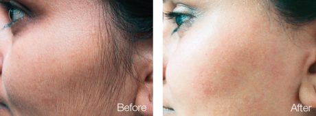 Laser Hair Removal Image