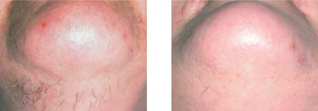 Laser Hair Removal Image