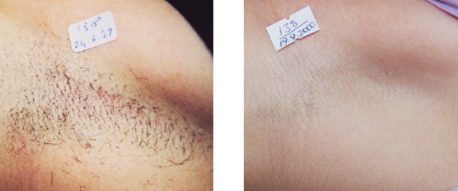 Laser Hair Removal Image