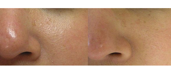 Corrective Skin