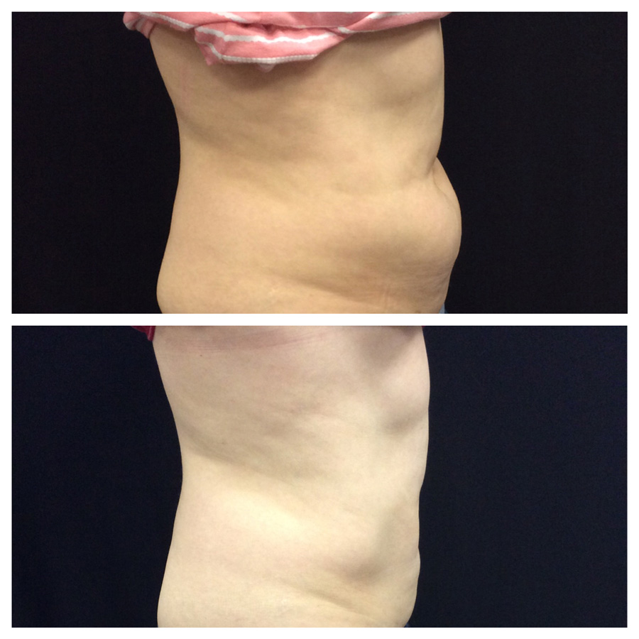 Body Contouring