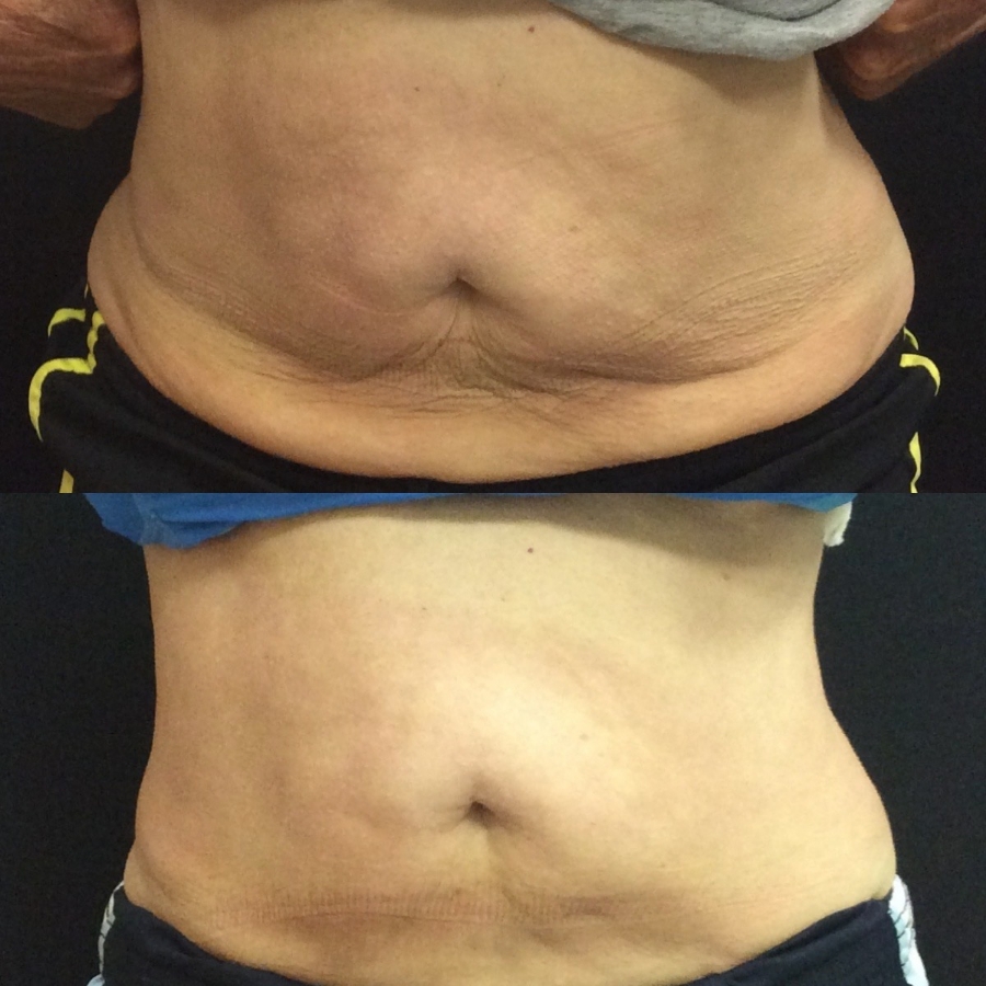 Body Contouring