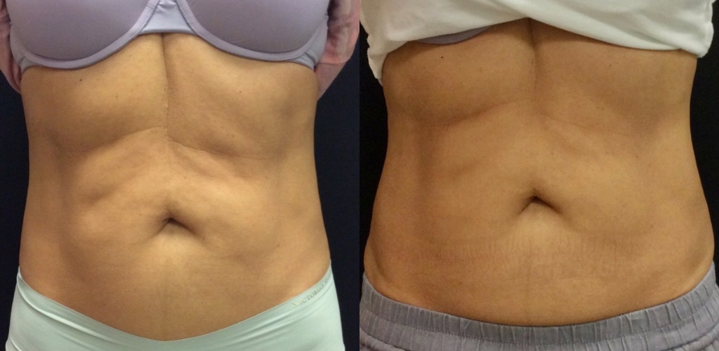 Body Contouring