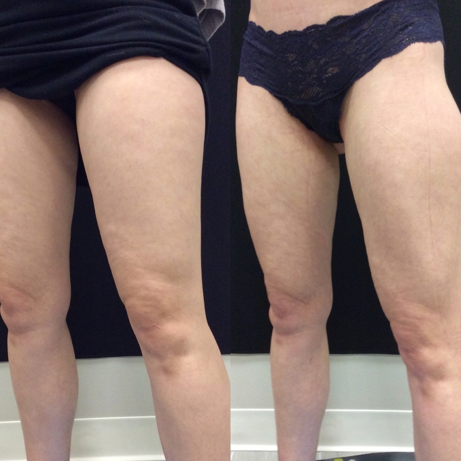 Body Contouring