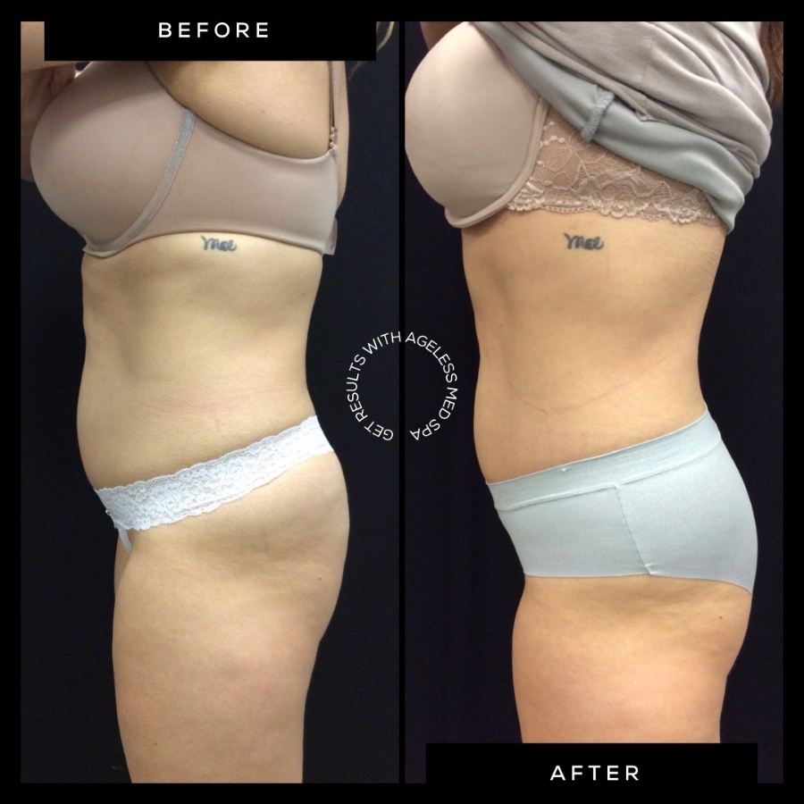 Body Contouring