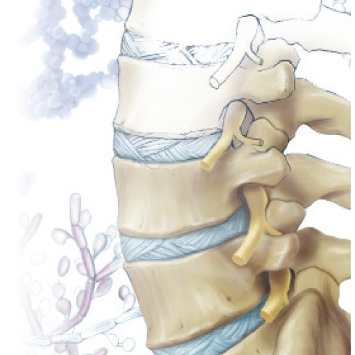 Spinal Infections | Canada East Spine Centre